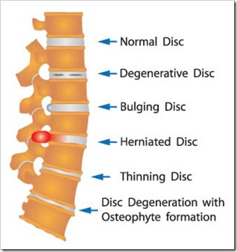 Back Pain Jackson MS Arthritis