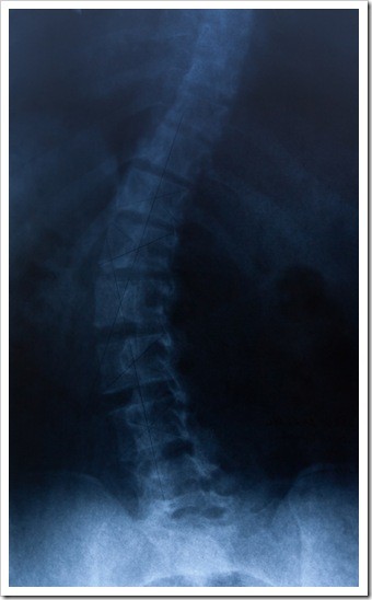 Jackson MS Scoliosis Treatment
